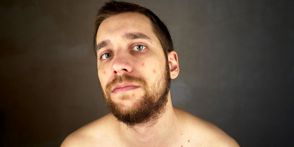 A bearded man with acne